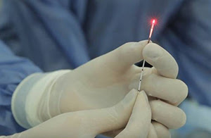 Actualización en Técnicas quirúrgicas en la cirugía de varices