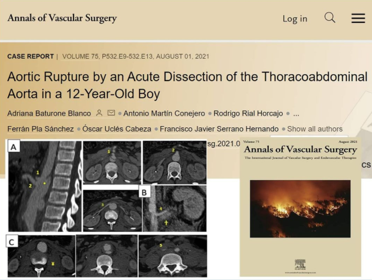 Dr. Rodrigo Rial coautor de una publicación en el Annals of Vascular Surgery. Disección y rotura aórtica en un niño de 12 años, con final feliz.